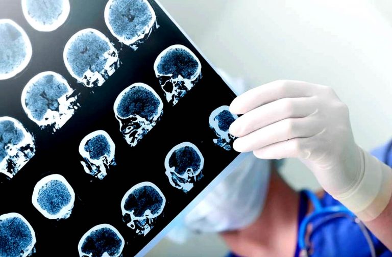 Especialista advierte que pacientes con ACV se  han demorado más en consultar por la pandemia