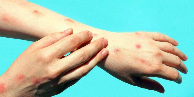 Minsal entrega recomendaciones ante  alerta sanitaria por Viruela del Mono