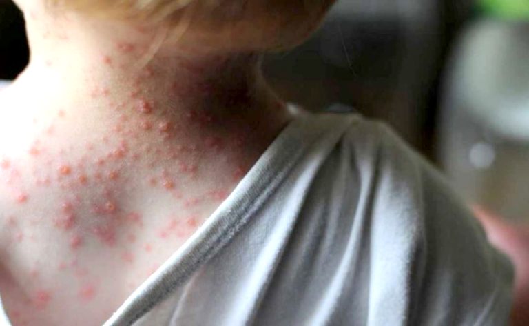 Seguir las recomendaciones de la autoridad de Salud: el llamado desde Sida Maule por arribo de la Viruela del Mono