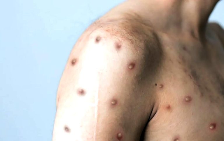 Epidemióloga recomienda reforzar sistema sanitario para enfrentar Viruela del Mono