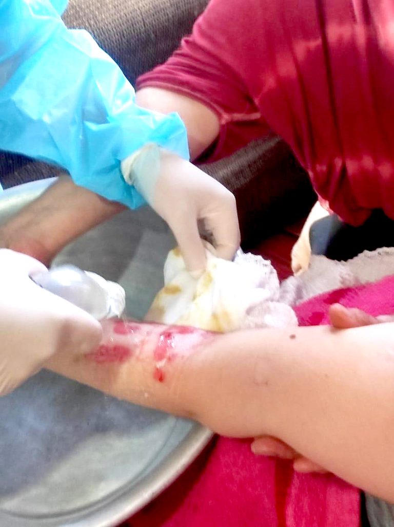 Denuncian que joven resultó quemada en presunto mal procedimiento