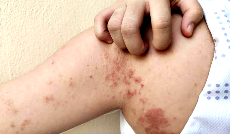 DAEM confirmó caso de escarlatina en alumno  de establecimiento educacional de Talca